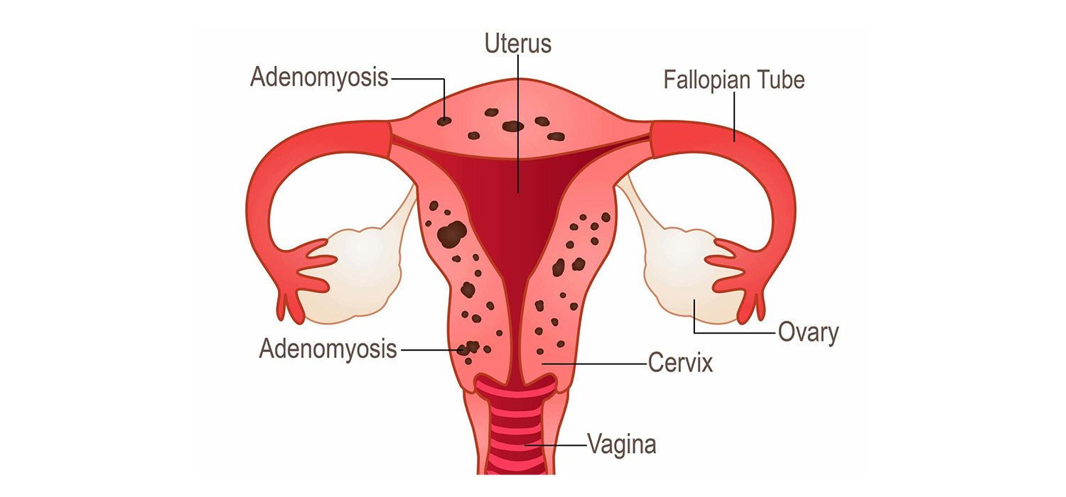 adenomyosis and infertility