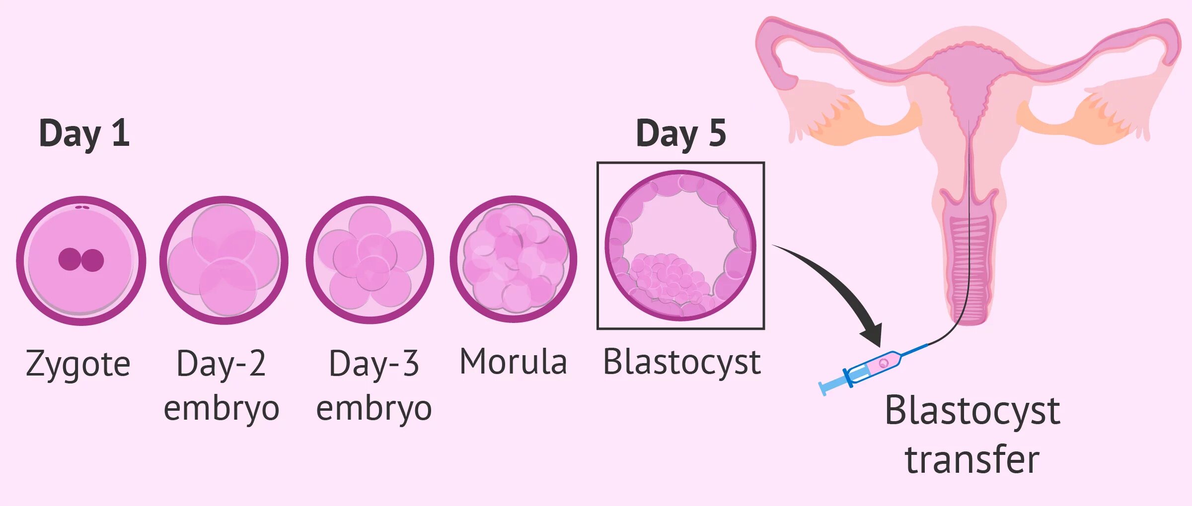 culture to blastocyst transfer