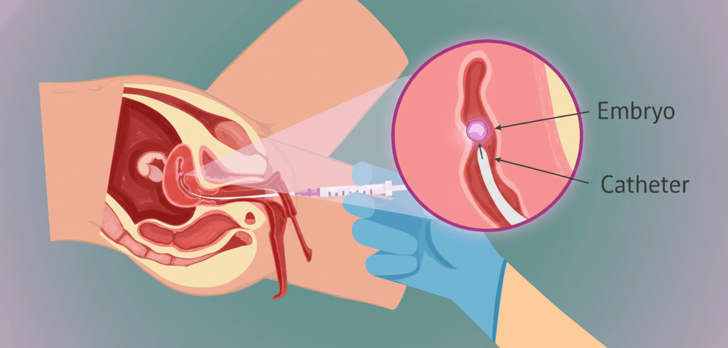 embryo transfer