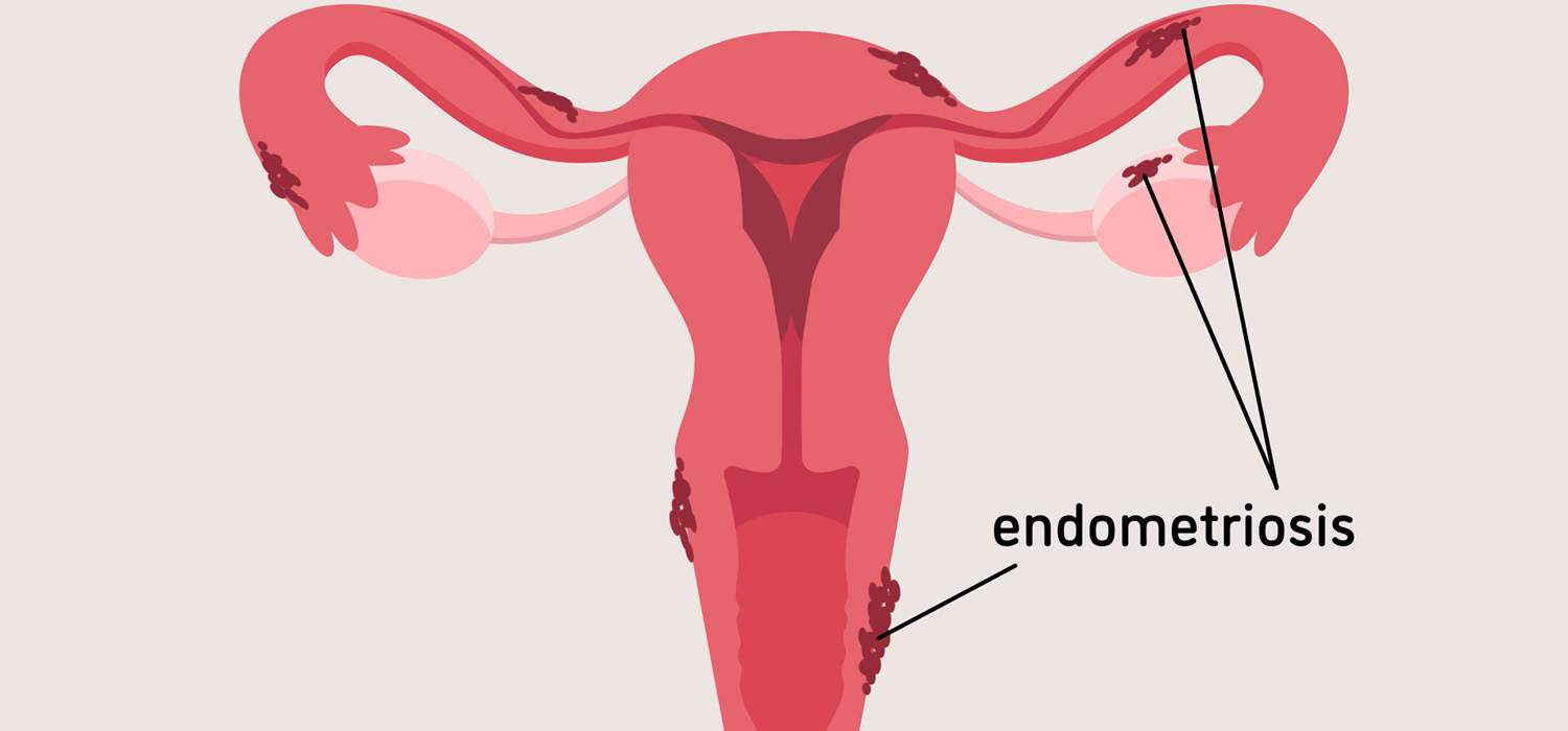 endometriosis clinical features and diagnosis