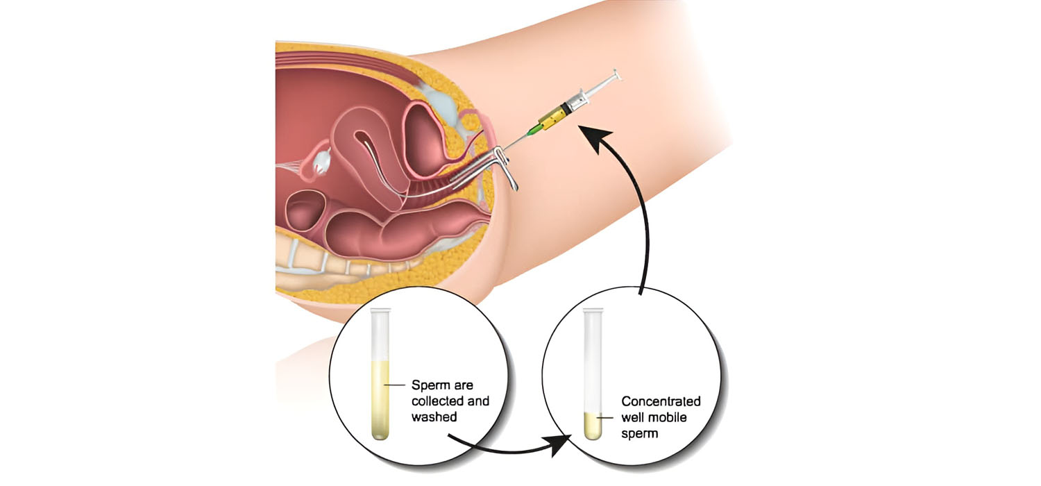 intrauterine insemination overview and indications