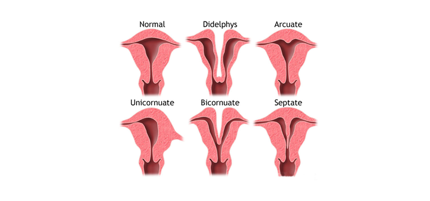 management of congenital uterine anomalies