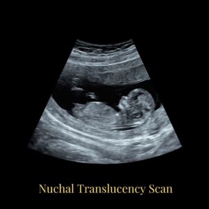 nuchal translucency scan