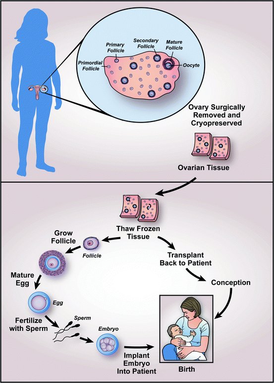 ovarian tissue cryopreservation