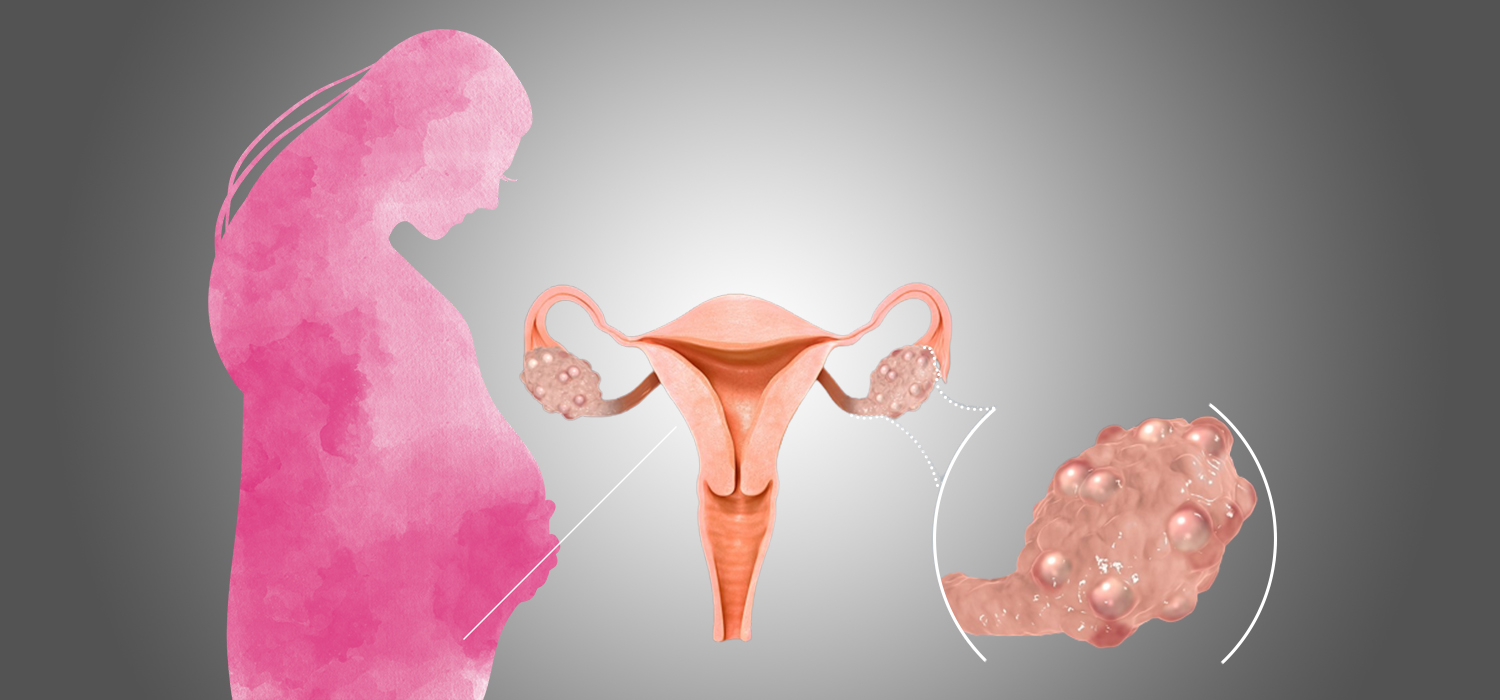 Polycystic Ovarian Syndrome and pregnancy