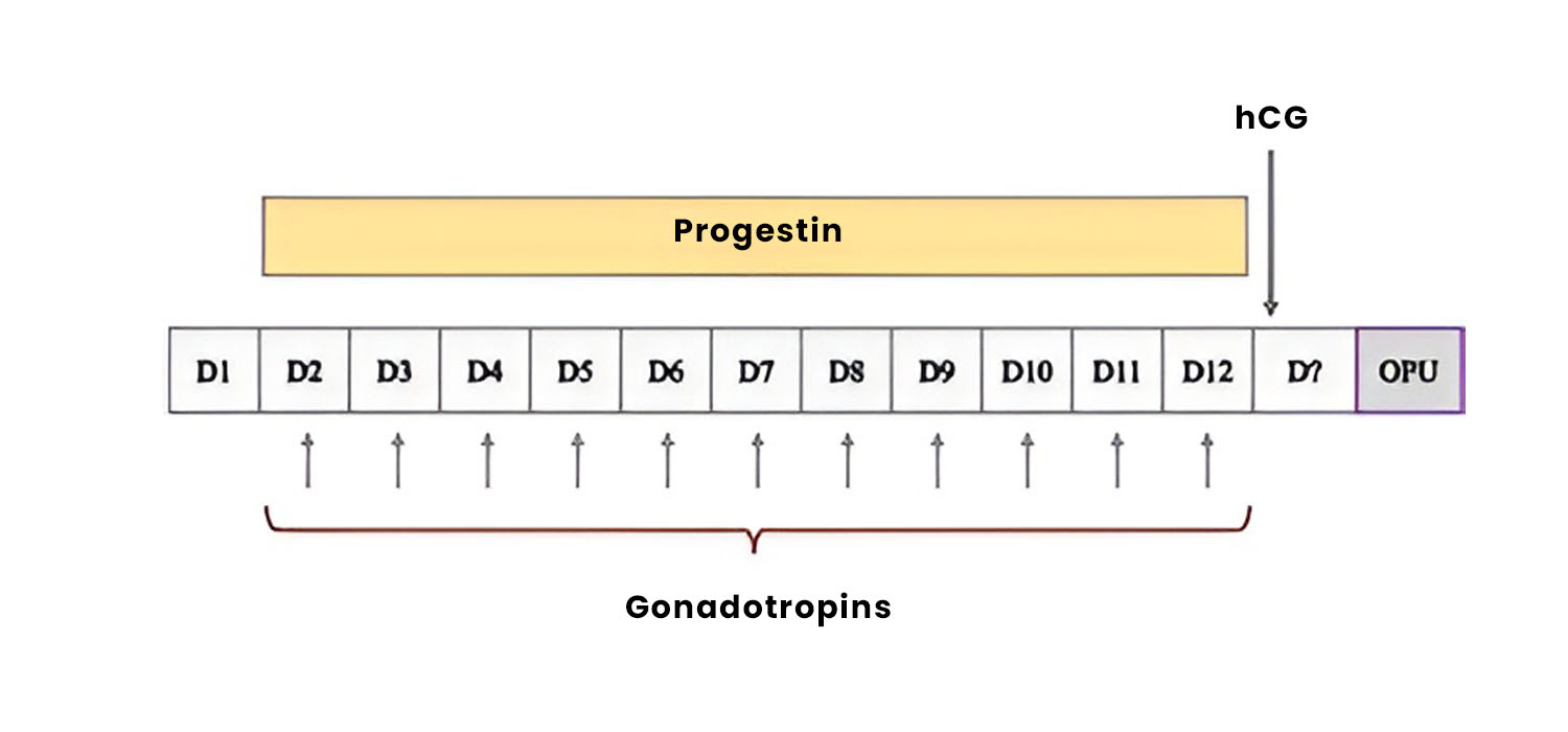 progesterone primed ovarian stimulation