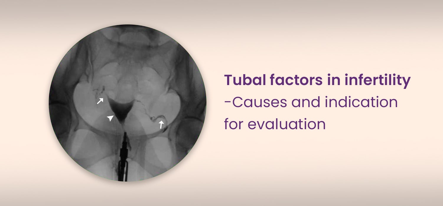 tubal factors in infertility