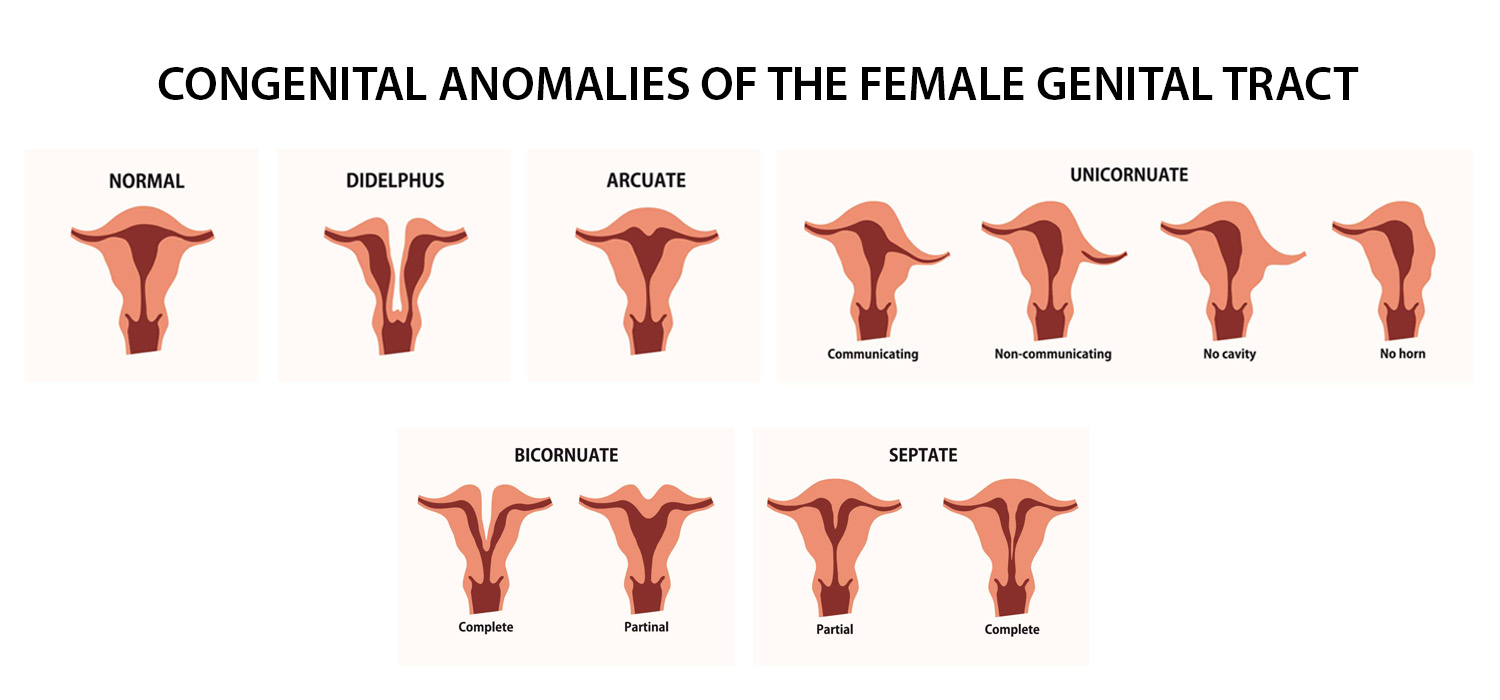 uterine factors in infertility