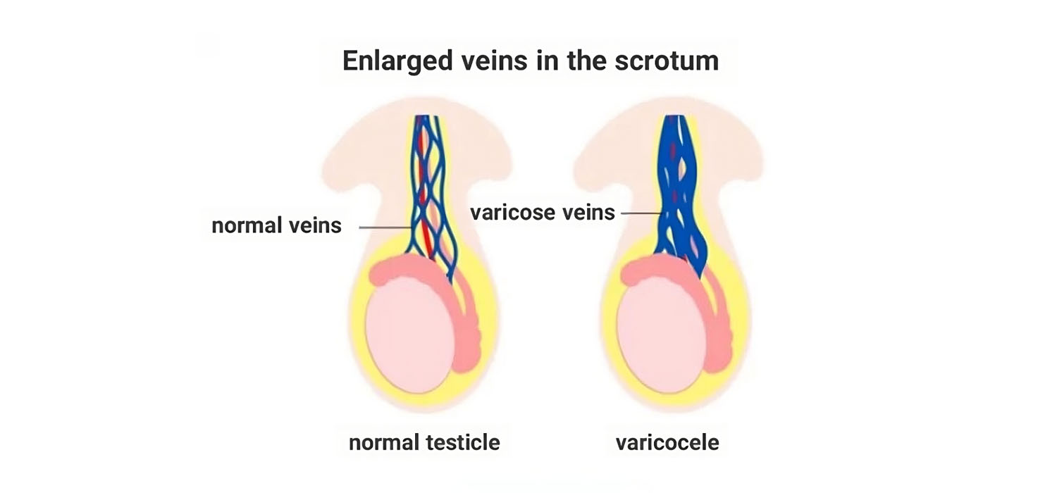varicocele and infertility