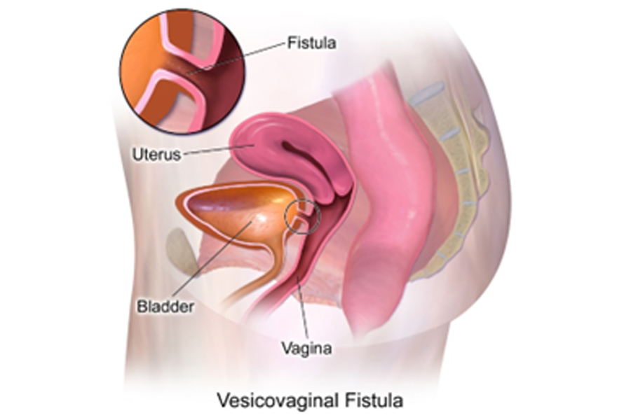 vesicovaginal fistula